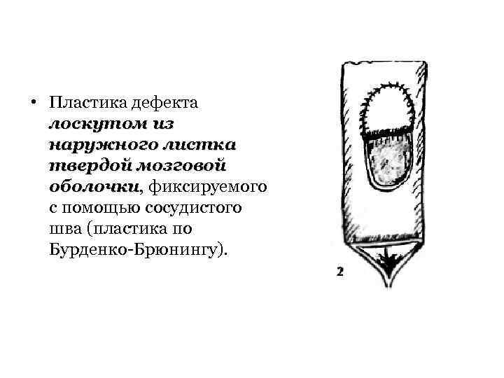  • Пластика дефекта лоскутом из наружного листка твердой мозговой оболочки, фиксируемого оболочки с