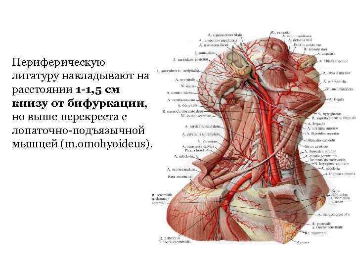 Периферическую лигатуру накладывают на расстоянии 1 -1, 5 см книзу от бифуркации, но выше