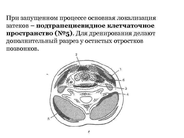 При запущенном процессе основная локализация затеков – подтрапециевидное клетчаточное пространство (№ 5). Для дренирования