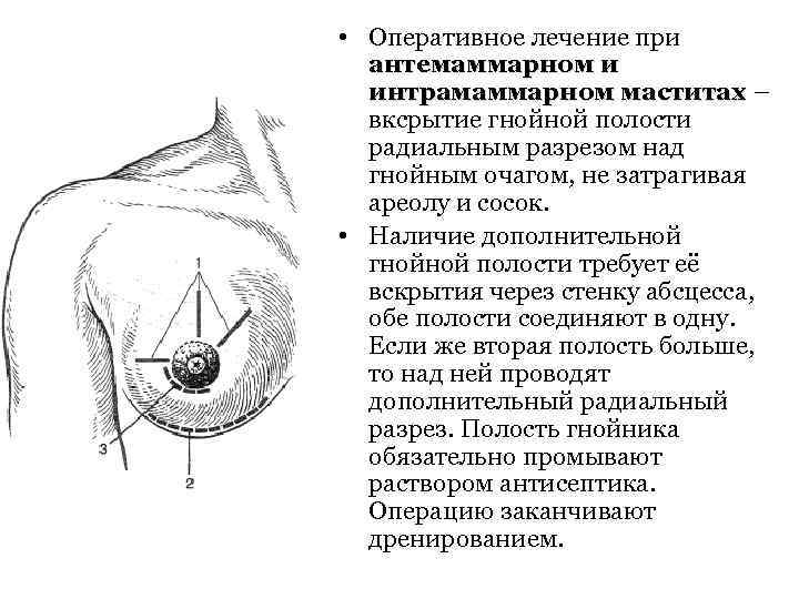  • Оперативное лечение при антемаммарном и интрамаммарном маститах – вксрытие гнойной полости радиальным