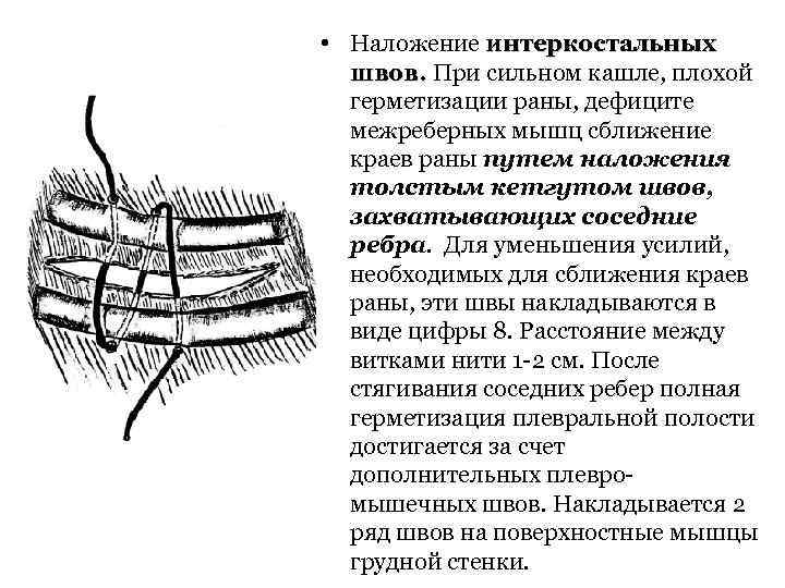 На какой из футляров стенки кишки наложение швов обеспечивает герметичность