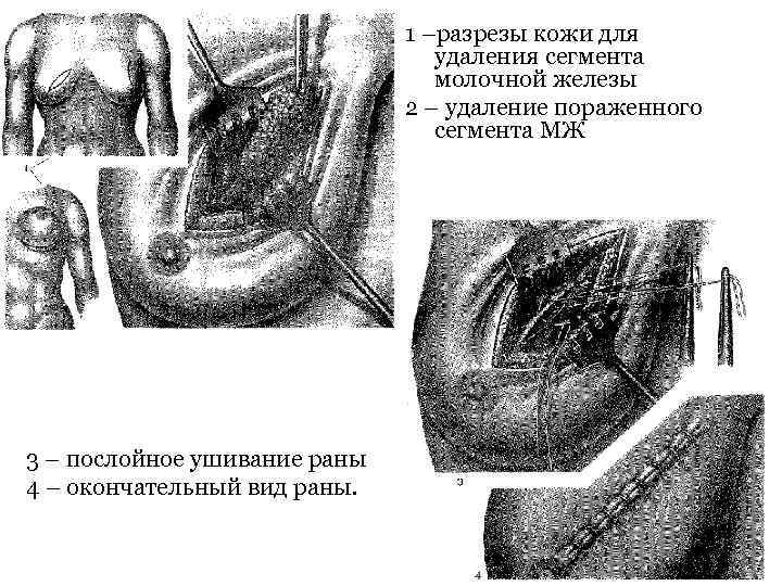 1 –разрезы кожи для удаления сегмента молочной железы 2 – удаление пораженного сегмента МЖ