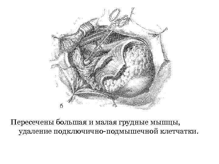 Пересечены большая и малая грудные мышцы, удаление подключично-подмышечной клетчатки. 