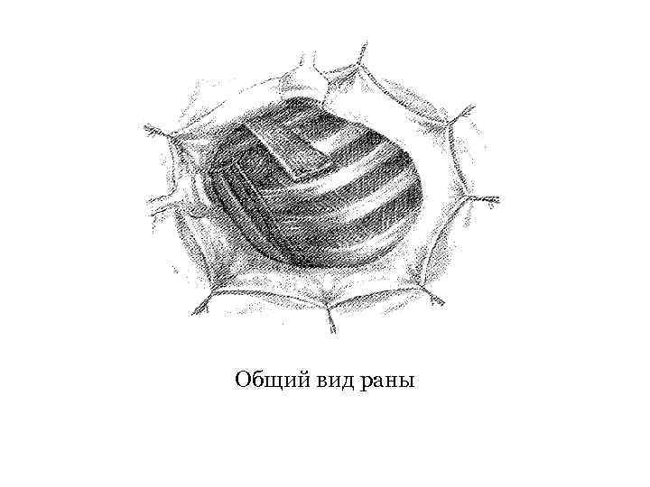 Общий вид раны 