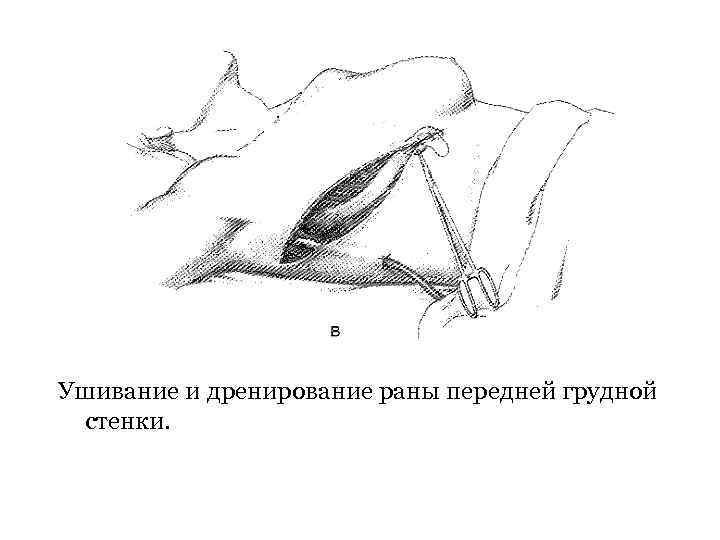 Ушивание и дренирование раны передней грудной стенки. 