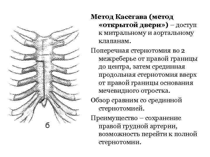 Метод Касегава (метод «открытой двери» ) – доступ к митральному и аортальному клапанам. Поперечная