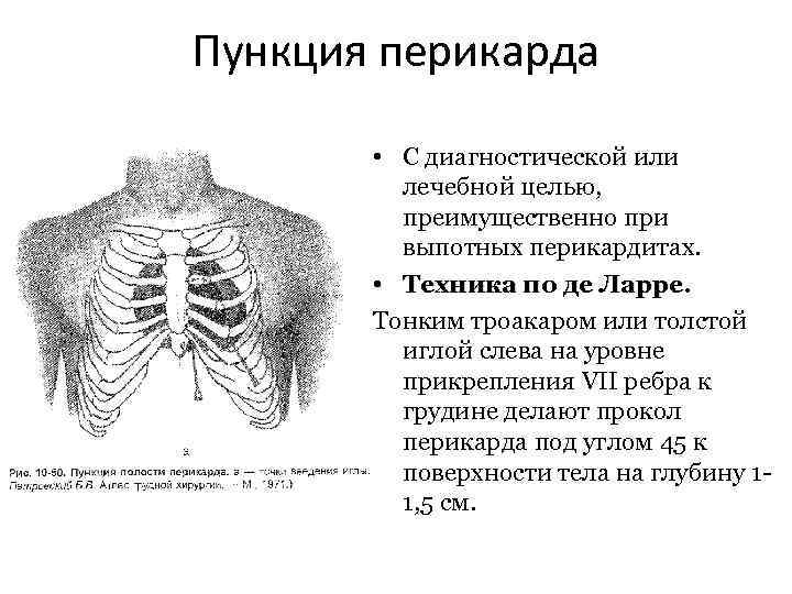 Пункция перикарда • С диагностической или лечебной целью, преимущественно при выпотных перикардитах. • Техника