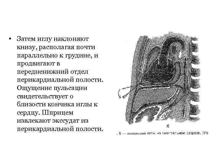  • Затем иглу наклоняют книзу, располагая почти параллельно к грудине, и продвигают в
