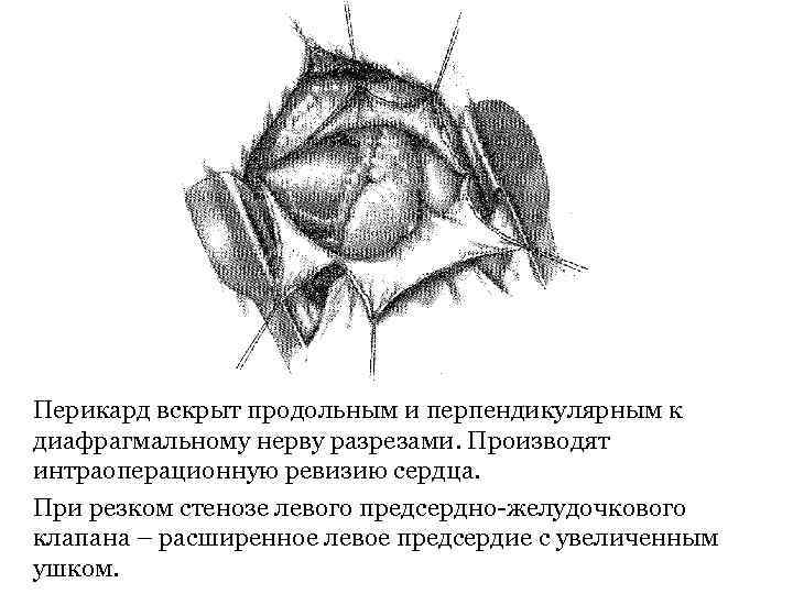 Перикард вскрыт продольным и перпендикулярным к диафрагмальному нерву разрезами. Производят интраоперационную ревизию сердца. При