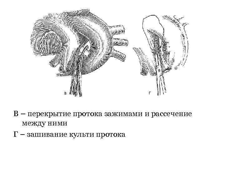 В – перекрытие протока зажимами и рассечение между ними Г – зашивание культи протока