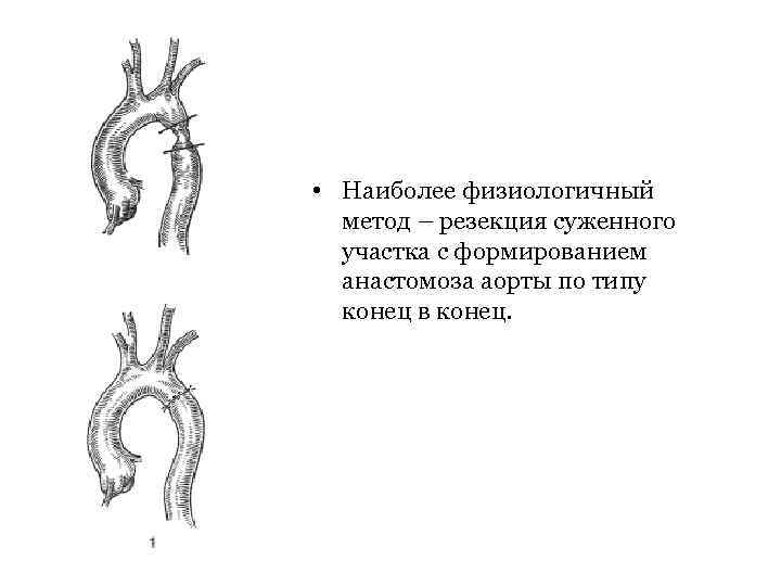  • Наиболее физиологичный метод – резекция суженного участка с формированием анастомоза аорты по