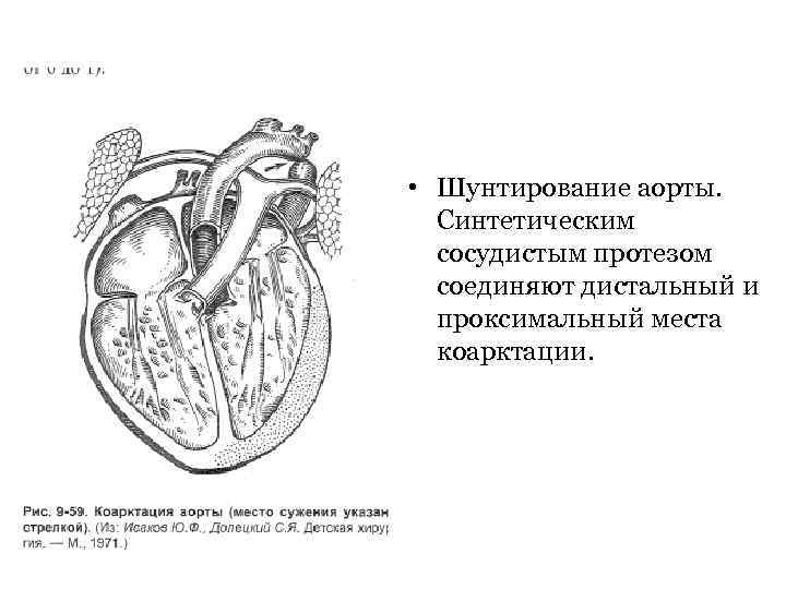  • Шунтирование аорты. Синтетическим сосудистым протезом соединяют дистальный и проксимальный места коарктации. 
