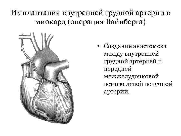 Имплантация внутренней грудной артерии в миокард (операция Вайнберга) • Создание анастомоза между внутренней грудной