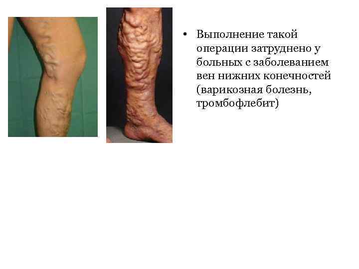  • Выполнение такой операции затруднено у больных с заболеванием вен нижних конечностей (варикозная