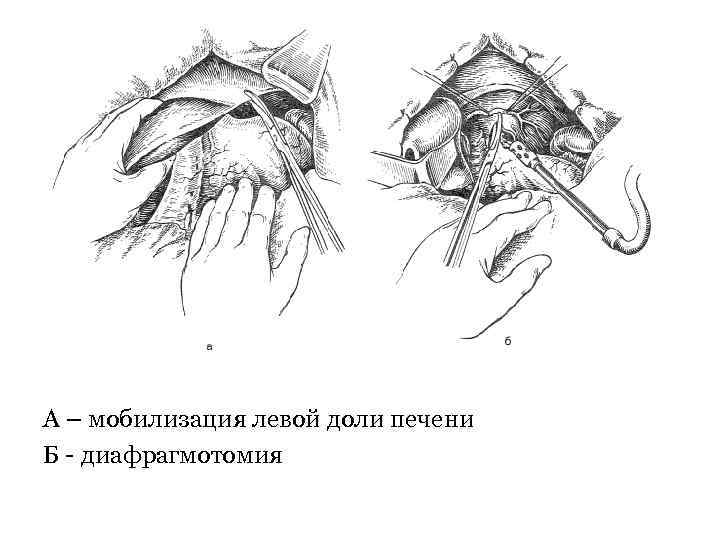 А – мобилизация левой доли печени Б - диафрагмотомия 