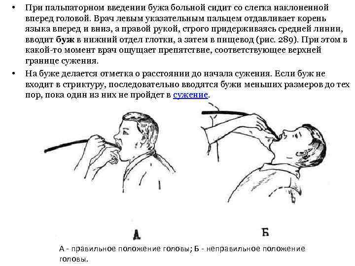  • • При пальпаторном введении бужа больной сидит со слегка наклоненной вперед головой.