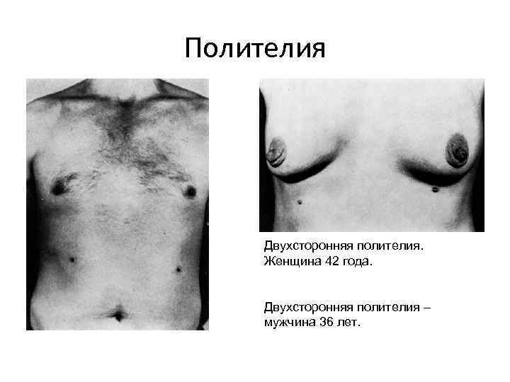 Полителия Двухсторонняя полителия. Женщина 42 года. Двухсторонняя полителия – мужчина 36 лет. 