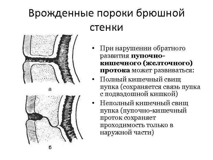 Врожденные пороки брюшной стенки • При нарушении обратного развития пупочнокишечного (желточного) протока может развиваться: