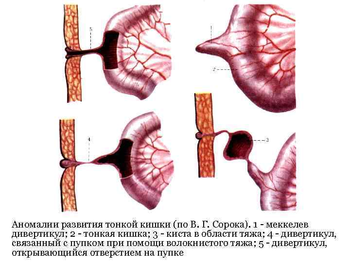 Аномалии развития тонкой кишки (по В. Г. Сорока). 1 - меккелев дивертикул; 2 -