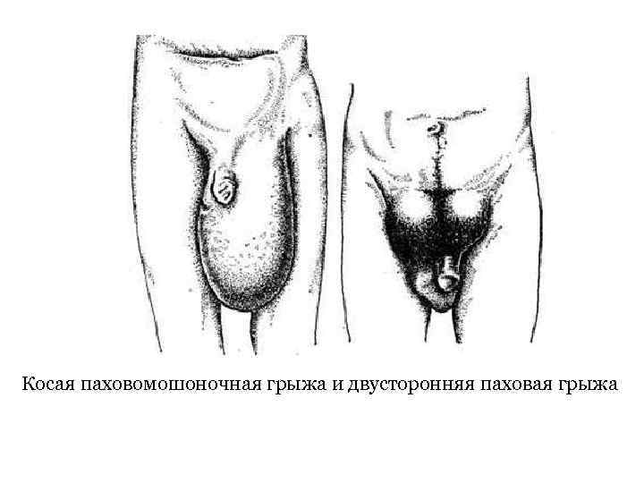 Косая паховомошоночная грыжа и двусторонняя паховая грыжа 