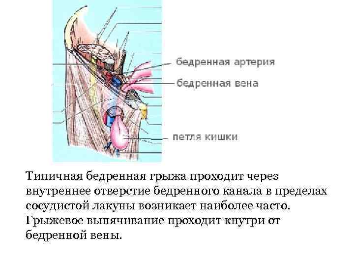 Типичная бедренная грыжа проходит через внутреннее отверстие бедренного канала в пределах сосудистой лакуны возникает