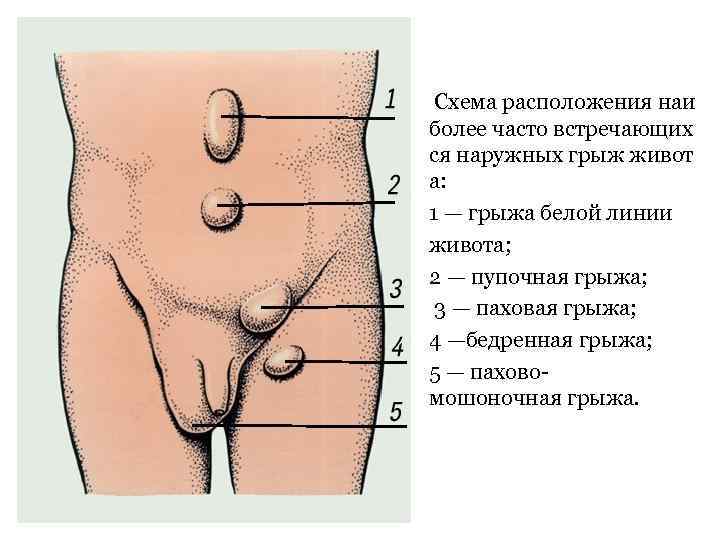  Схема расположения наи более часто встречающих ся наружных грыж живот а: 1 —