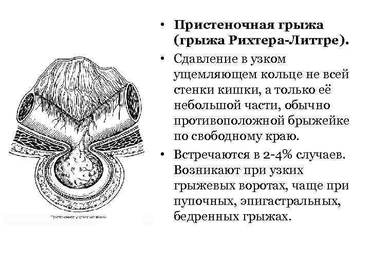 Какова клиническая картина при рихтеровском ущемлении