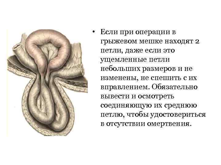  • Если при операции в грыжевом мешке находят 2 петли, даже если это
