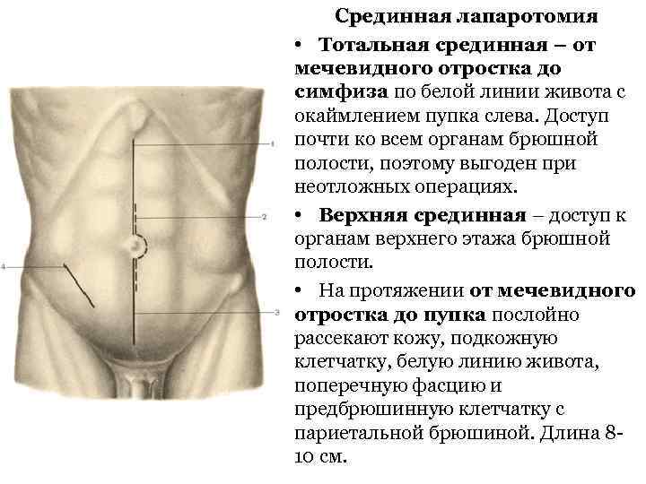 Срединная лапаротомия • Тотальная срединная – от мечевидного отростка до симфиза по белой линии
