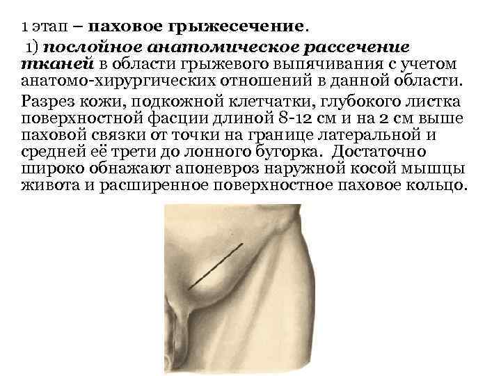 1 этап – паховое грыжесечение. 1) послойное анатомическое рассечение тканей в области грыжевого выпячивания