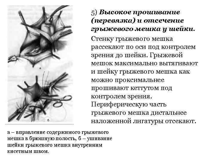 5) Высокое прошивание (перевязка) и отсечение грыжевого мешка у шейки. Стенку грыжевого мешка рассекают