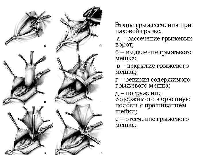 Этапы грыжесечения при паховой грыже. а – рассечение грыжевых ворот; б – выделение грыжевого