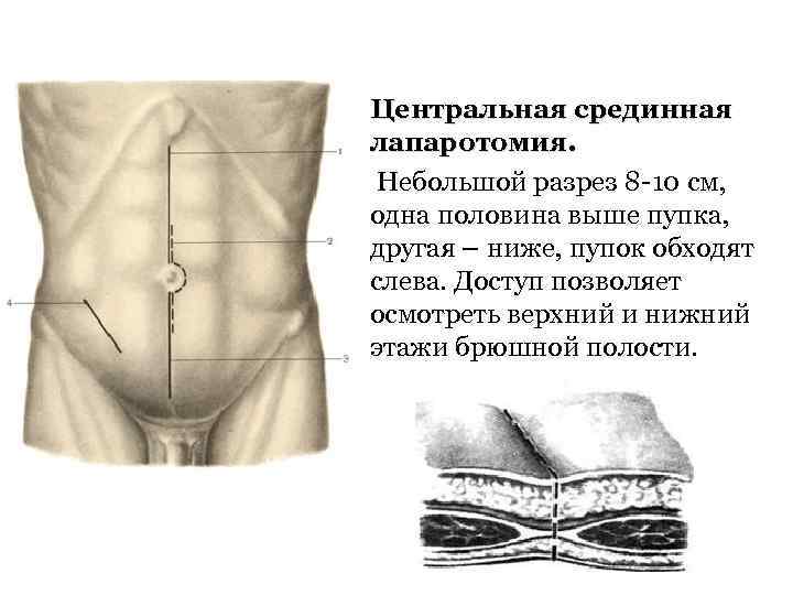 Центральная срединная лапаротомия. Небольшой разрез 8 -10 см, одна половина выше пупка, другая –
