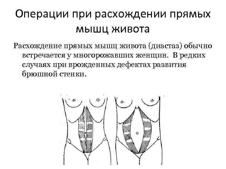 Операции при расхождении прямых мышц живота Расхождение прямых мышц живота (диастаз) обычно встречается у