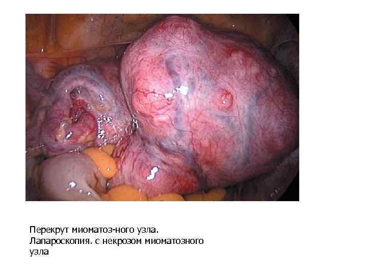  • Перекрут миоматоз-ного узла. Лапароскопия. с некрозом миоматозного узла 
