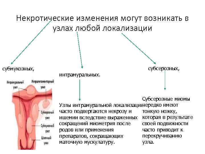 Некротические изменения могут возникать в узлах любой локализации субмукозных, субсерозных, интрамуральных. Субсерозные миомы нередко