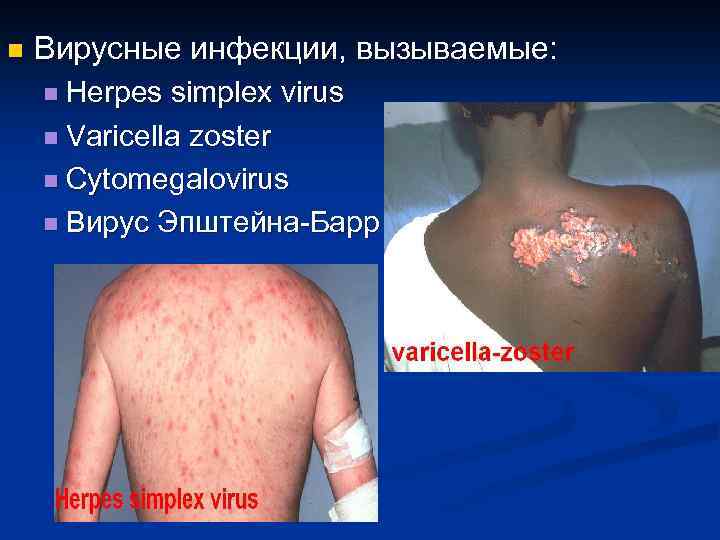 n Вирусные инфекции, вызываемые: n Herpes simplex virus n Varicella zoster n Cytomegalovirus n