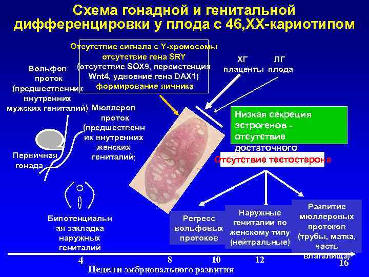 Схема гонадной и генитальной дифференцировки у плода с 46, ХХ-кариотипом Отсутствие сигнала с Y-хромосомы