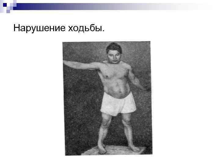 Нарушение ходьбы. 
