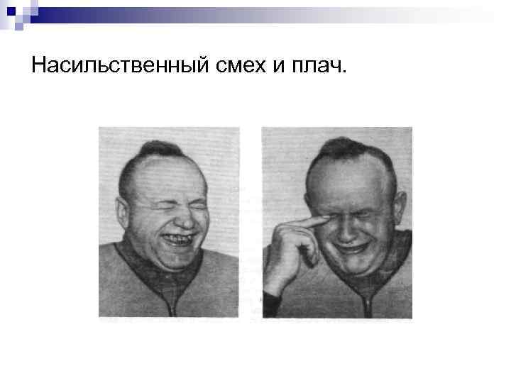 Насильственный смех и плач. 