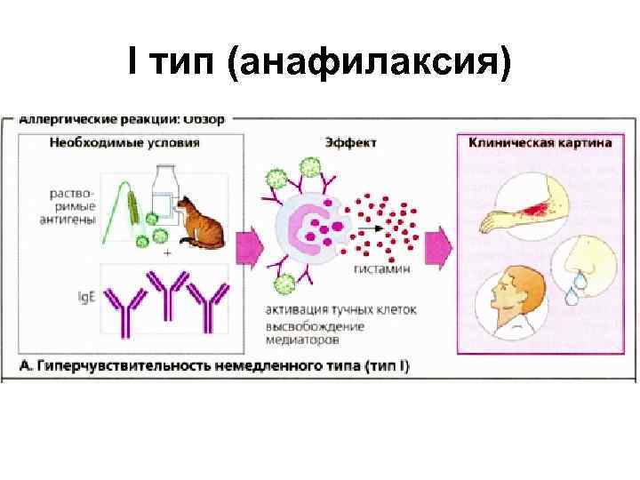 I тип (анафилаксия) 