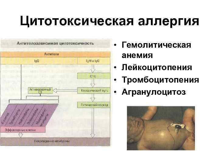 Цитотоксическая аллергия • Гемолитическая анемия • Лейкоцитопения • Тромбоцитопения • Агранулоцитоз 