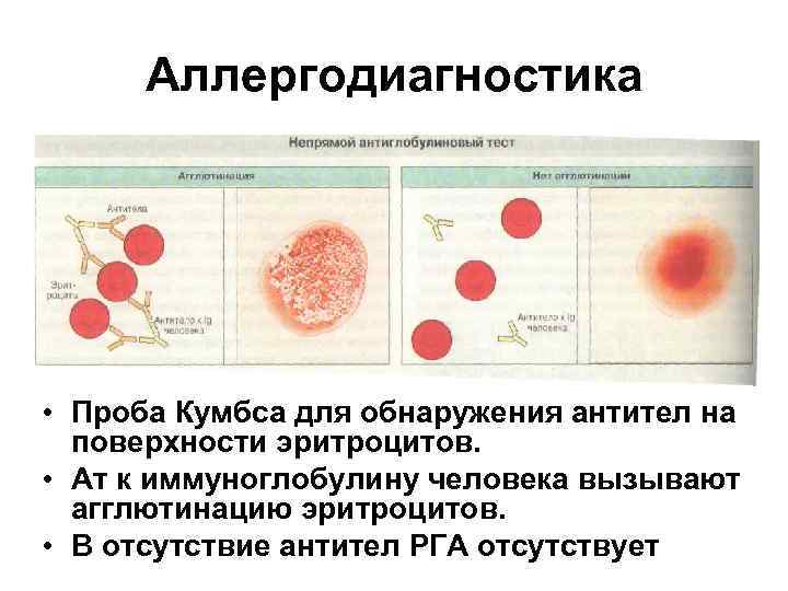 Аллергодиагностика • Проба Кумбса для обнаружения антител на поверхности эритроцитов. • Ат к иммуноглобулину