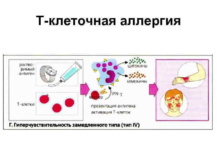 Т-клеточная аллергия 