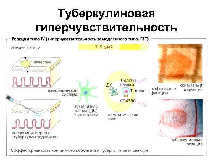 Туберкулиновая гиперчувствительность 