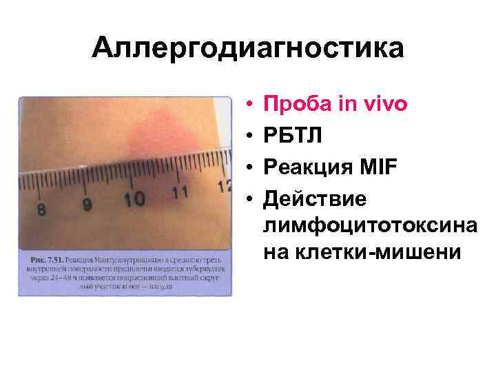 Аллергодиагностика • • Проба in vivo РБТЛ Реакция MIF Действие лимфоцитотоксина на клетки-мишени 