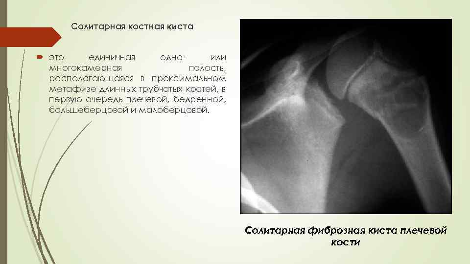 Солитарная костная киста это единичная одноили многокамерная полость, располагающаяся в проксимальном метафизе длинных трубчатых