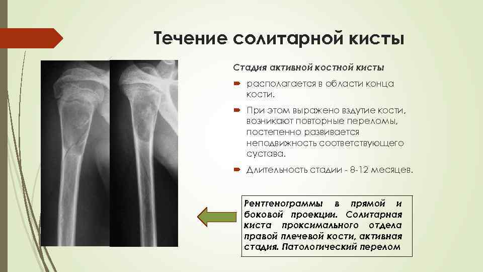 Течение солитарной кисты Стадия активной костной кисты располагается в области конца кости. При этом