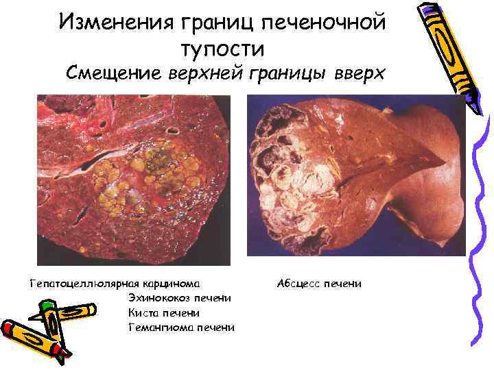 Изменения границ печеночной тупости Смещение верхней границы вверх Гепатоцеллюлярная карцинома Эхинококоз печени Киста печени