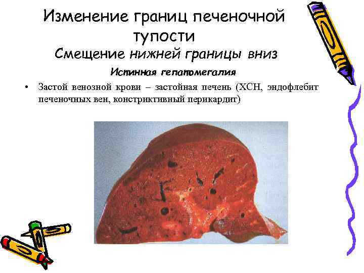 Изменение границ печеночной тупости Смещение нижней границы вниз Истинная гепатомегалия • Застой венозной крови